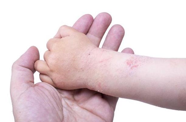 湿疹造成的原因有什么呢？湿疹治疗注意事项有哪些？