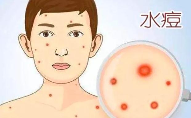 为什么会得水痘呢？得水痘有什么危害吗？