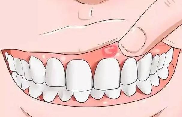 牙龈肿痛含盐水有用吗？西瓜霜能治牙龈肿痛吗？